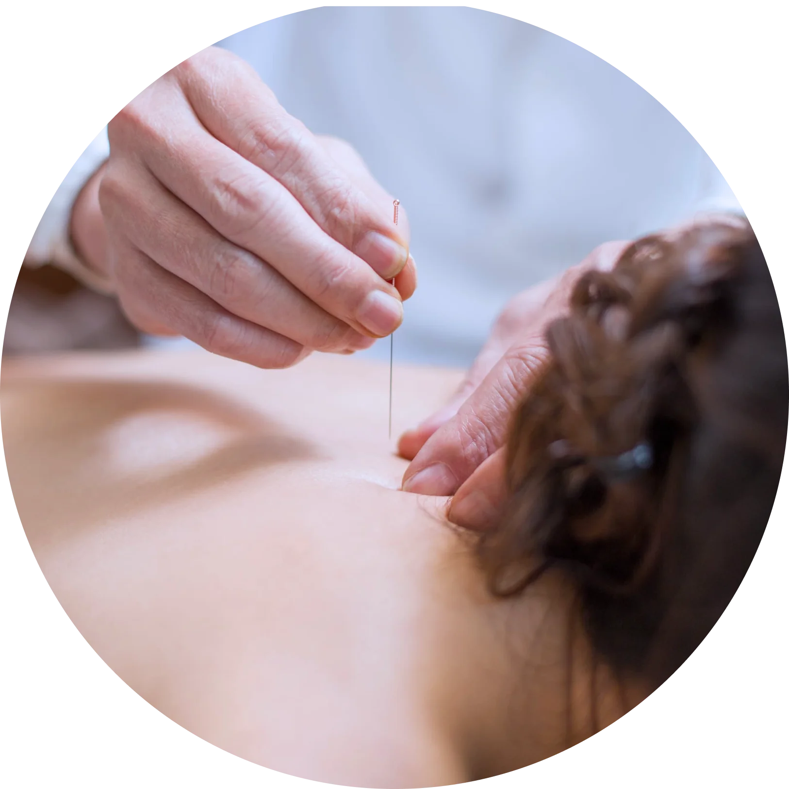 Dry Needling and Acupuncture in Ashford