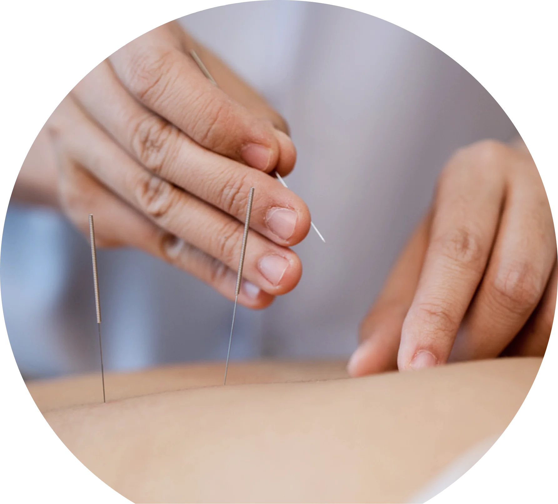 Dry Needling in Ashford