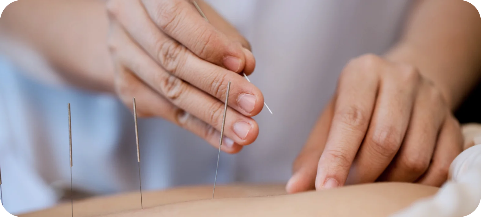 Dry Needling