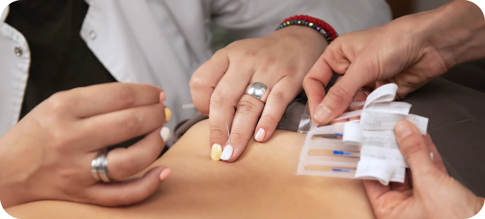 Traditional Acupuncture